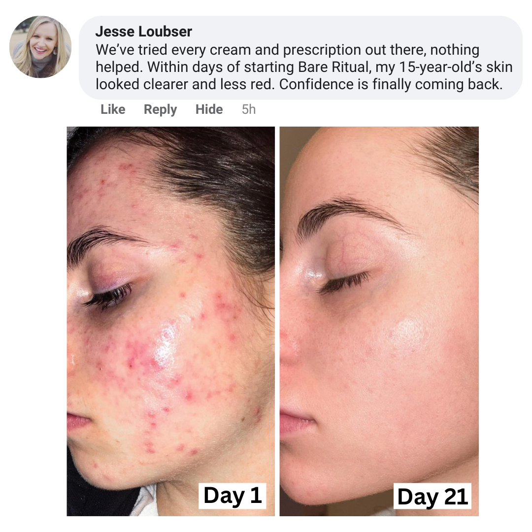 3-in-1 Acne & Redness Rescue Kit