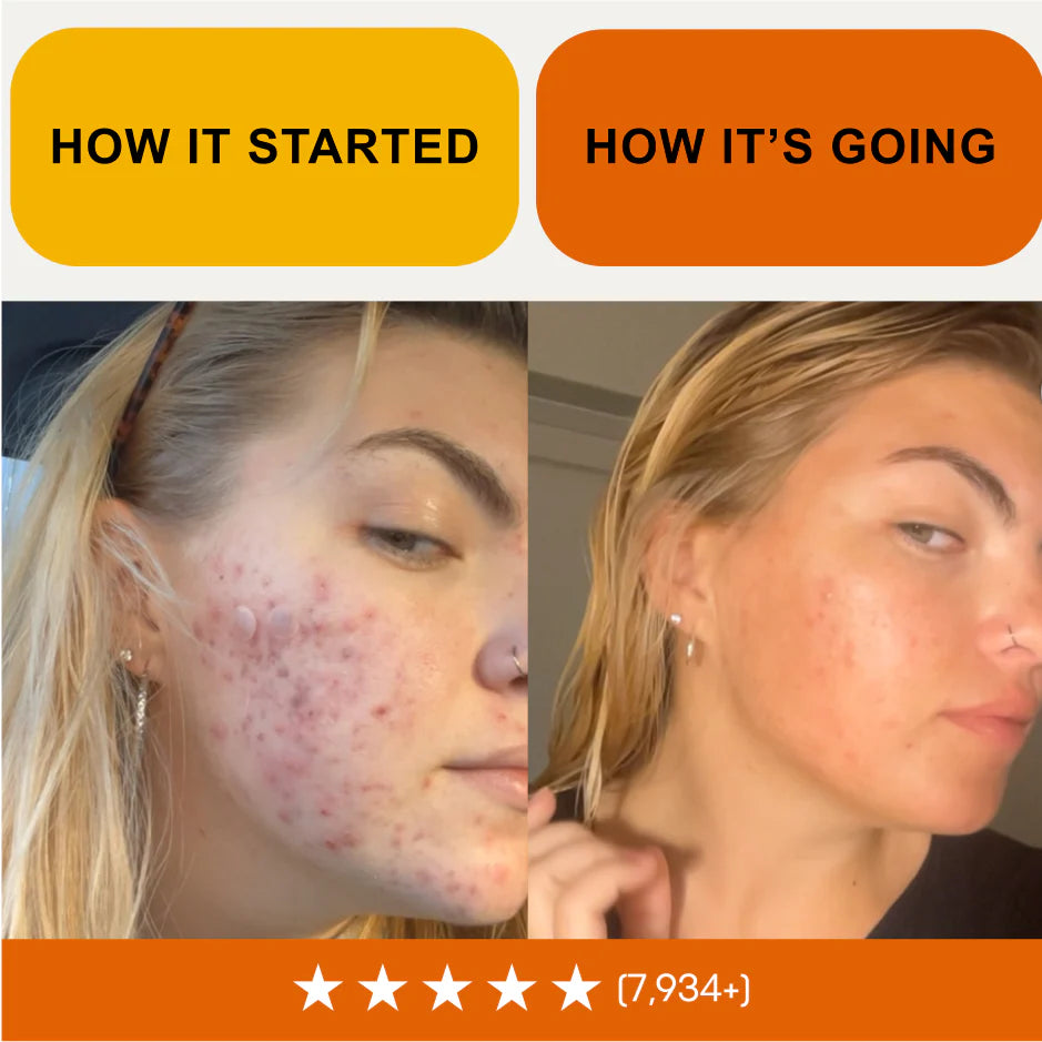 3-in-1 Acne & Redness Rescue Kit